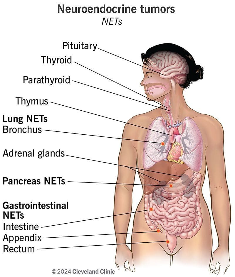 Where neuroendocrine tumors occur in the body